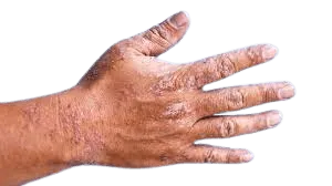 Cracked, very dry or healing skin